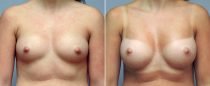 Dr. Conway Breast Augmentation