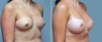 breast-augmentation-10977-27b-conway