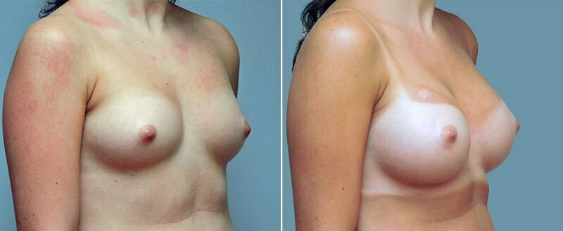 breast-augmentation-10977-27b-conway