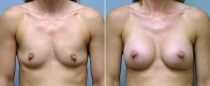 Dr. Conway Breast Augmentation