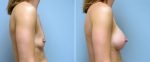 breast-augmentation-10977-3c-conway