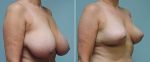 breast-reduction-14207-11b-conway