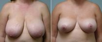 Dr. Conway Breast Reduction