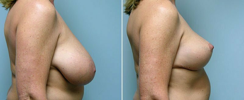 breast-reduction-14207-31c-conway