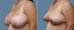 breast-reduction-14207-39b-conway