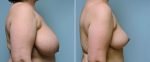 breast-reduction-14207-3c-conway