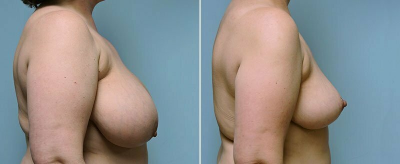 breast-reduction-14207-3c-conway