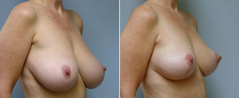 breast-reduction-14207-7b-conway