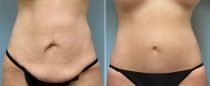 Dr. Conway Tummy Tuck