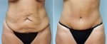 tummy-tuck-14305-3a-conway