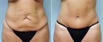 Dr. Conway Tummy Tuck