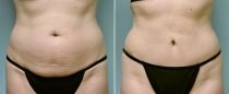 Dr. Conway Tummy Tuck