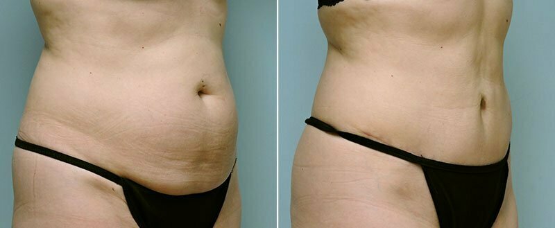 tummy-tuck-14305-7b-conway